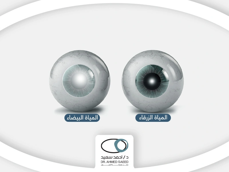 المياة-البيضاء-والزرقاء-في-العين (1) المياه البيضاء والزرقاء في العين