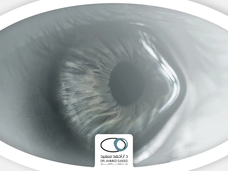 علاج القرنية المخروطية