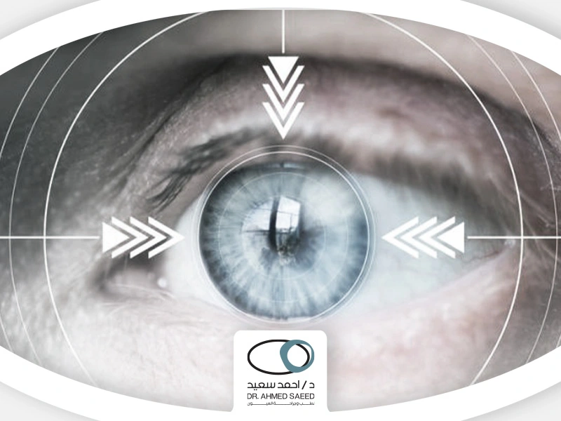 عملية-زراعة-القرنية-بالليزر عملية زراعة القرنية