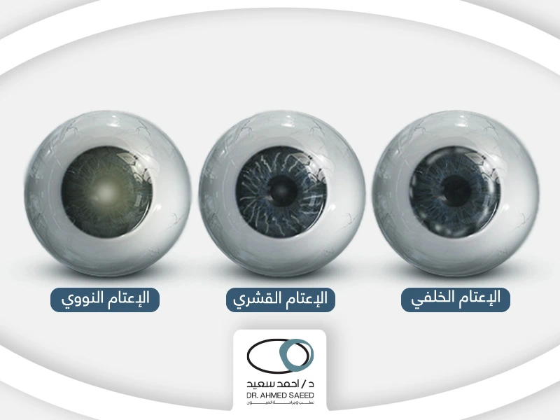 أنواع-المياة-البيضاء-في-العين أنواع المياه البيضاء في العين